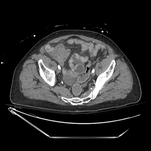 File:Closed loop obstruction due to adhesive band, resulting in small bowel ischemia and resection (Radiopaedia 83835-99023 B 128).jpg