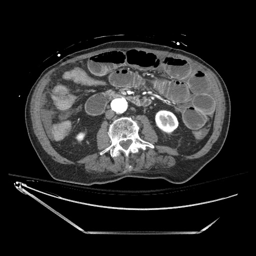 Closed loop obstruction due to adhesive band, resulting in small bowel ischemia and resection (Radiopaedia 83835-99023 B 75).jpg