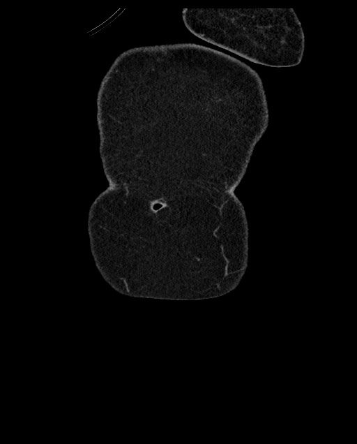 Closed loop small bowel obstruction - adhesions (Radiopaedia 59269-66611 B 7).jpg