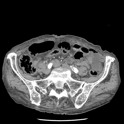 Closed loop small bowel obstruction - adhesions and infarct (Radiopaedia 85125-100678 A 127).jpg