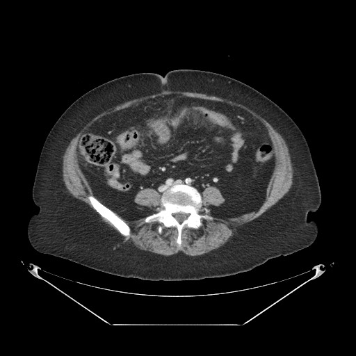 Closed loop small bowel obstruction - internal hernia (Radiopaedia 65402-74450 A 81).jpg