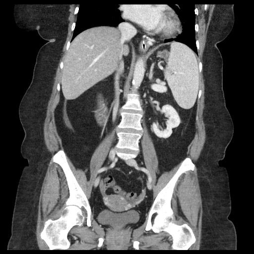 Closed loop small bowel obstruction - internal hernia (Radiopaedia 65402-74450 B 64).jpg