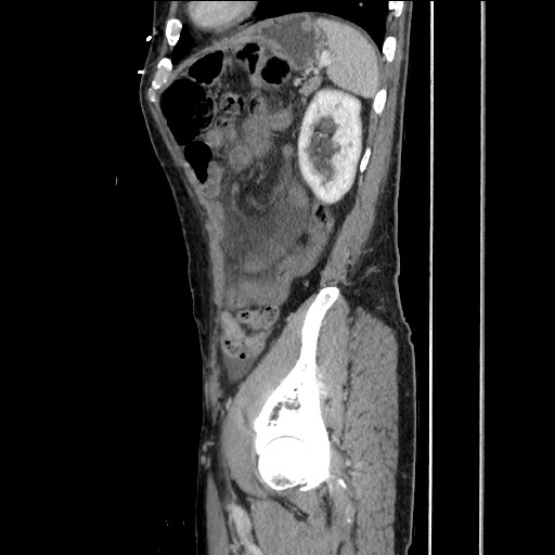 Closed loop small bowel obstruction - omental adhesion causing "internal hernia" (Radiopaedia 85129-100682 C 138).jpg