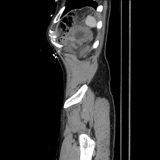 Closed loop small bowel obstruction - omental adhesion causing "internal hernia" (Radiopaedia 85129-100682 C 159).jpg