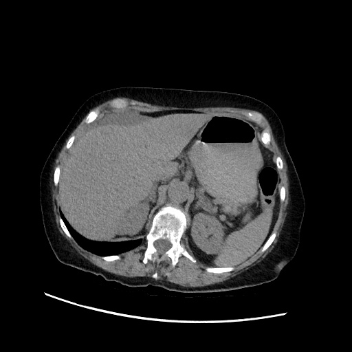 Closed loop small bowel obstruction due to adhesive band, with intramural hemorrhage and ischemia (Radiopaedia 83831-99017 Axial non-contrast 44).jpg