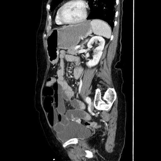 File:Closed loop small bowel obstruction due to adhesive band, with intramural hemorrhage and ischemia (Radiopaedia 83831-99017 D 126).jpg