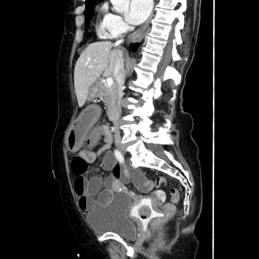 Closed loop small bowel obstruction due to adhesive band, with intramural hemorrhage and ischemia (Radiopaedia 83831-99017 D 98).jpg