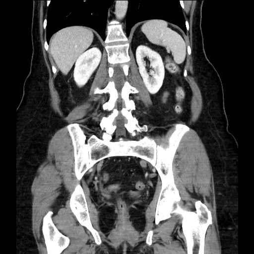 Closed loop small bowel obstruction due to adhesive bands - early and late images (Radiopaedia 83830-99014 B 87).jpg