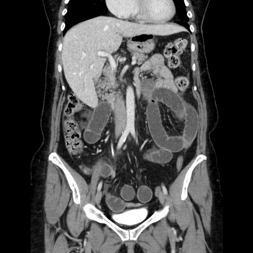 Closed loop small bowel obstruction due to adhesive bands - early and late images (Radiopaedia 83830-99015 B 55).jpg