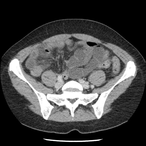 File:Closed loop small bowel obstruction due to trans-omental herniation (Radiopaedia 35593-37109 A 61).jpg