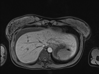 Closed loop small bowel obstruction in pregnancy (MRI) (Radiopaedia 87637-104031 Axial T1 fat sat 19).jpg