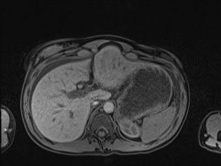 Closed loop small bowel obstruction in pregnancy (MRI) (Radiopaedia 87637-104031 Axial T1 fat sat 29).jpg