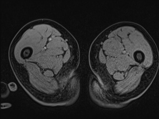 Closed loop small bowel obstruction in pregnancy (MRI) (Radiopaedia 87637-104031 G 54).jpg