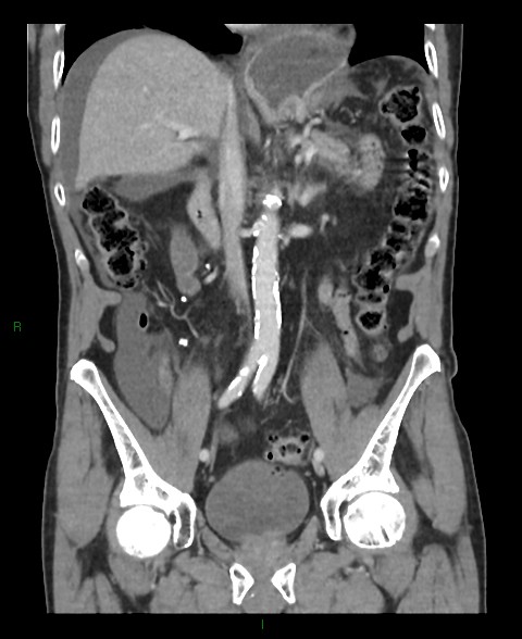 Closed loop small bowel obstruction with ischemia (Radiopaedia 84180-99456 B 33).jpg