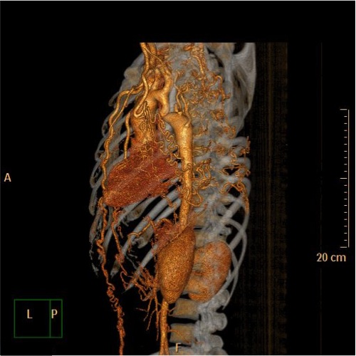 File:Coarctation of the aorta (Radiopaedia 40877-43571 A 4).jpg