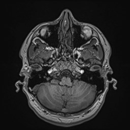 Cochlear incomplete partition type III associated with hypothalamic hamartoma (Radiopaedia 88756-105498 Axial T1 52).jpg