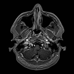Cochlear incomplete partition type III associated with hypothalamic hamartoma (Radiopaedia 88756-105498 Axial T1 C+ 38).jpg