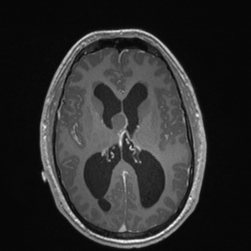 File:Colloid cyst (Radiopaedia 44510-48181 Axial T1 C+ 100).png