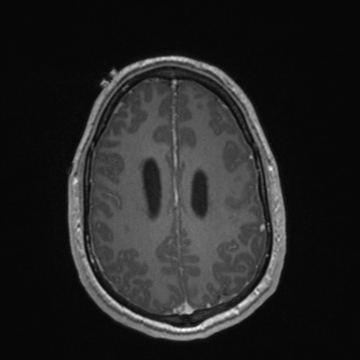 File:Colloid cyst (Radiopaedia 44510-48181 Axial T1 C+ 135).png