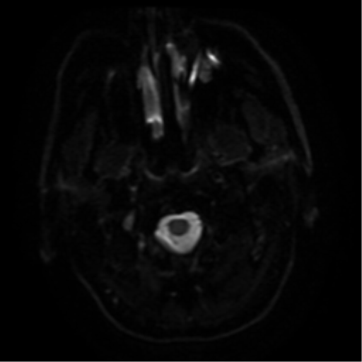 File:Colloid cyst (large) (Radiopaedia 34415-35729 Axial DWI 22).png