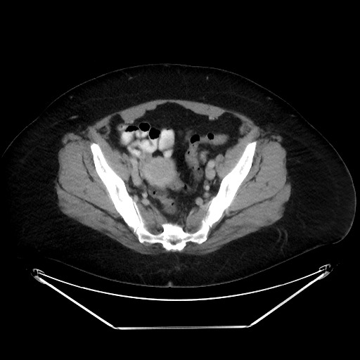 File:Colonic intussusception due to adenocarcinoma (Radiopaedia 86828-102987 A 123).jpg