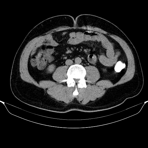 File:Colonic lipoma with colo-colic intussusception (Radiopaedia 58944-66200 Axial C+ rectal 36).jpg
