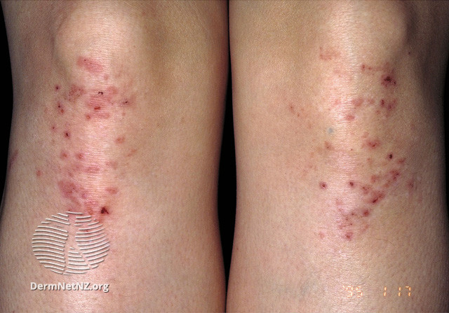 File:Dermatitis herpetiformis (DermNet NZ immune-s-dh5).jpg