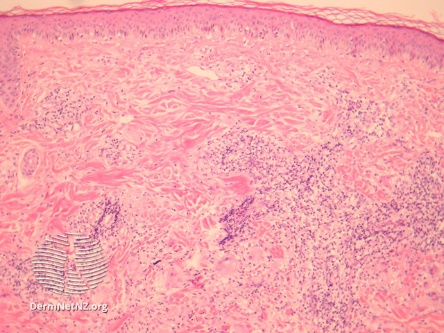 File:Figure 1 (DermNet NZ pathology-e-annular-elastolytic-granuloma-figure-1).jpg