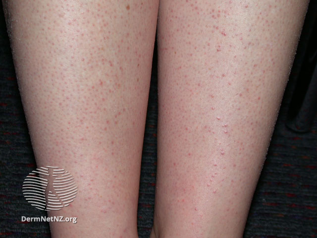 File:Folliculitis due to hair removal (DermNet NZ hair-nails-sweat-removal-foll1).jpg