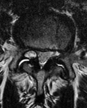 File:Intraspinal synovial cyst (Radiopaedia 14352).jpg