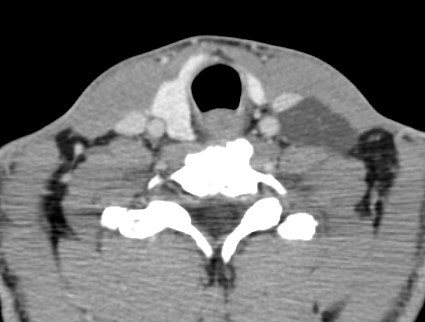 File:Lymphangioma of the neck (Radiopaedia 15889).jpg