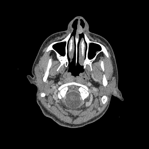 Nasal pyogenic granuloma (lobular capillary hemangioma) (Radiopaedia 85536-101244 C 25).jpg