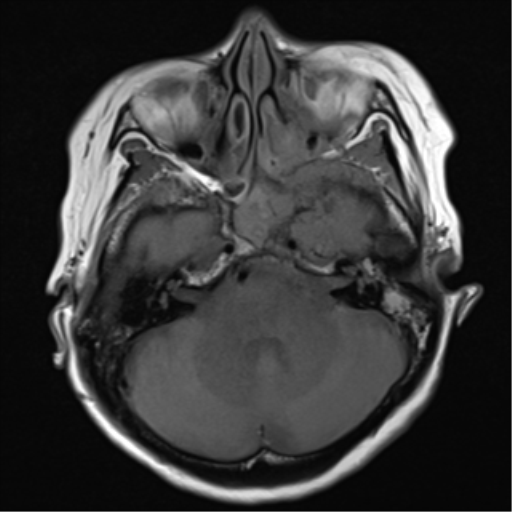 File:Nasopharyngeal carcinoma with cerebral abscess (Radiopaedia 43018-46273 Axial T1 14).png