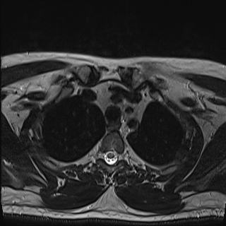 Nasopharyngeal carcinoma with perineural spread (Radiopaedia 55030-61380 Axial T2 90).jpg