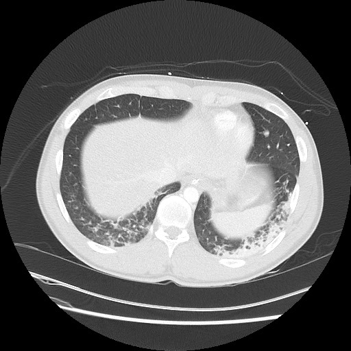 Near-drowning pulmonary edema (Radiopaedia 59457-66814 Axial lung window 47).jpg