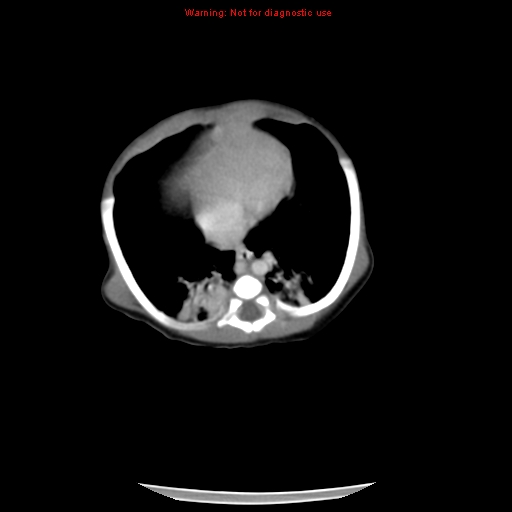 File:Neonatal neuroblastoma (Radiopaedia 9564-10223 A 12).jpg