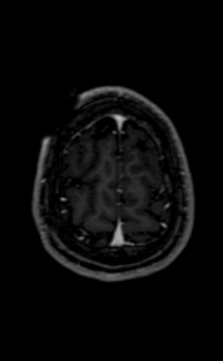 Neuro-Behçet disease (Radiopaedia 90112-107294 Axial T1 C+ 64).jpg