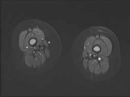 File:Neuroblastoma with bone metastases (Radiopaedia 67080-76414 Axial STIR 22).jpg