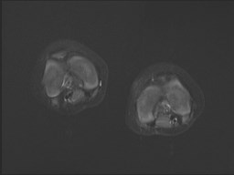 File:Neuroblastoma with bone metastases (Radiopaedia 67080-76414 Axial STIR 6).jpg