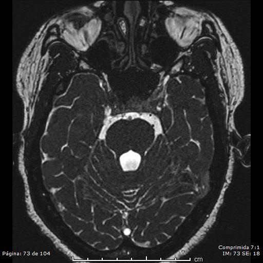 Neurocysticercosis (Radiopaedia 58636-65832 I 73).jpg