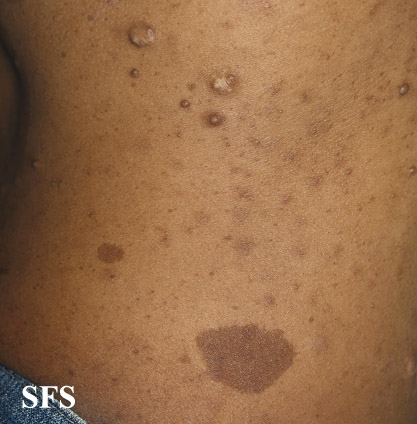 File:Neurofibromatosis (Dermatology Atlas 71).jpg