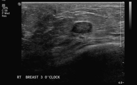File:Neurofibromatosis of breast (Radiopaedia 5921-7462 F 1).jpg