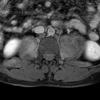 File:Neurofibromatosis type 1- extensive spinal involvement and Christmas tree sign (Radiopaedia 60610-68332 Axial T1 C+ fat sat 69).jpg