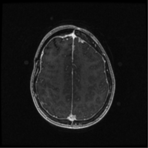 Neurofibromatosis type 2 (Radiopaedia 45229-49244 Axial T1 C+ 86).png