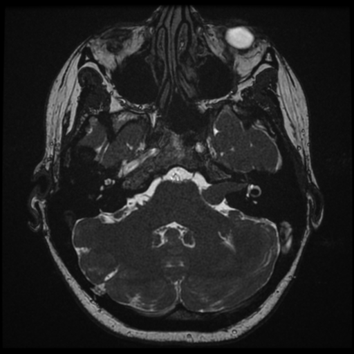 Neurofibromatosis type 2 - bilateral acoustic neuromata (Radiopaedia 40060-42566 Axial FIESTA 35).png