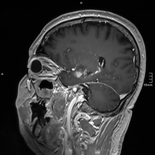 Neurosarcoidosis - involvement of the mesial temporal lobes (Radiopaedia 67429-76820 Sagittal T1 C+ 111).jpg