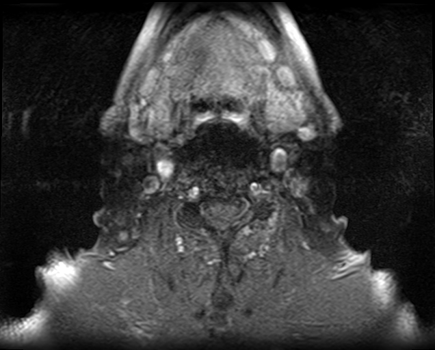 File:Non-Hodgkin lymphoma - parotid gland (Radiopaedia 71531-81890 Axial T1 C+ fat sat 5).jpg