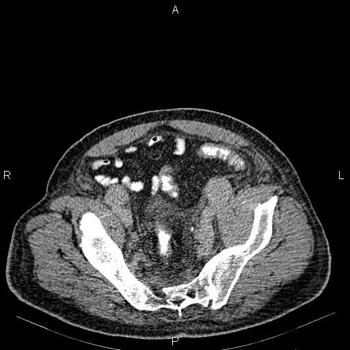 Non Hodgkin lymphoma in a patient with ankylosing spondylitis (Radiopaedia 84323-99621 Axial C+ delayed 66).jpg