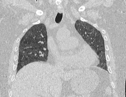 Non specific interstitial pneumonia (NSIP) (Radiopaedia 89725-106798 Coronal lung window 34).jpg