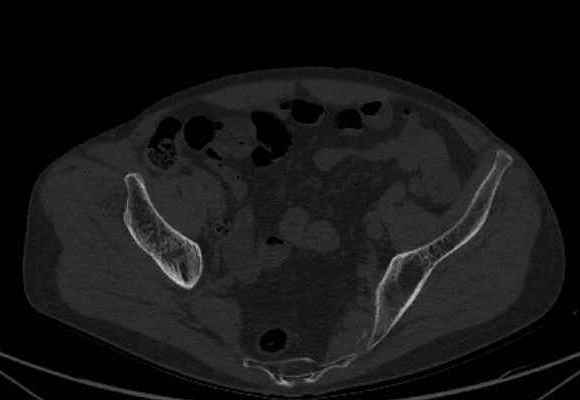 File:Nondisplaced incomplete intertrochanteric fracture (Radiopaedia 73736-84539 Axial bone window 6).jpg